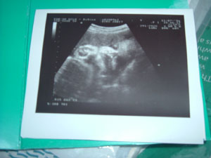 baby untrasound picture